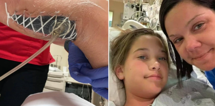 Una niña de 12 años se infectó con una bacteria come carne durante unas vacaciones en Florida