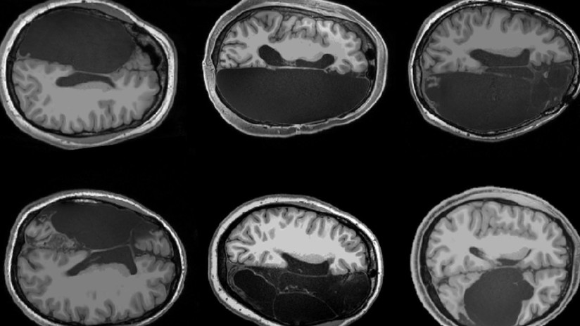 Científicos muestran cómo se reconectan neuronas en personas sin un hemisferio cerebral