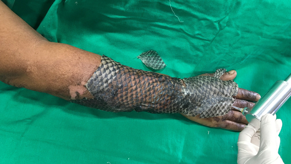 El pez que puede curar quemaduras y reconstruir vaginas que revolucionó la medicina en Brasil