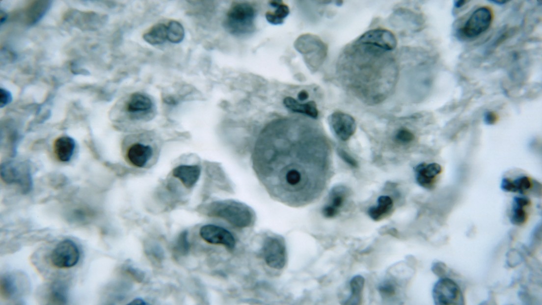 Confirman un caso de infección por una ameba que destruye el cerebro en Florida