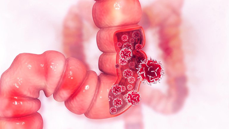 EEUU: aumentan los casos de cáncer de colon entre los menores de 50 años
