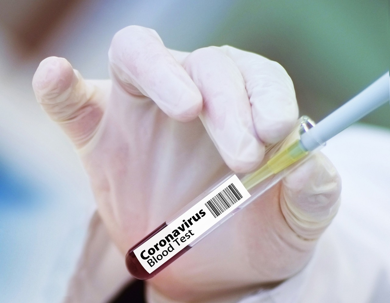 Coronavirus en RD | 314 casos y 2 muertes en las últimas 24 horas