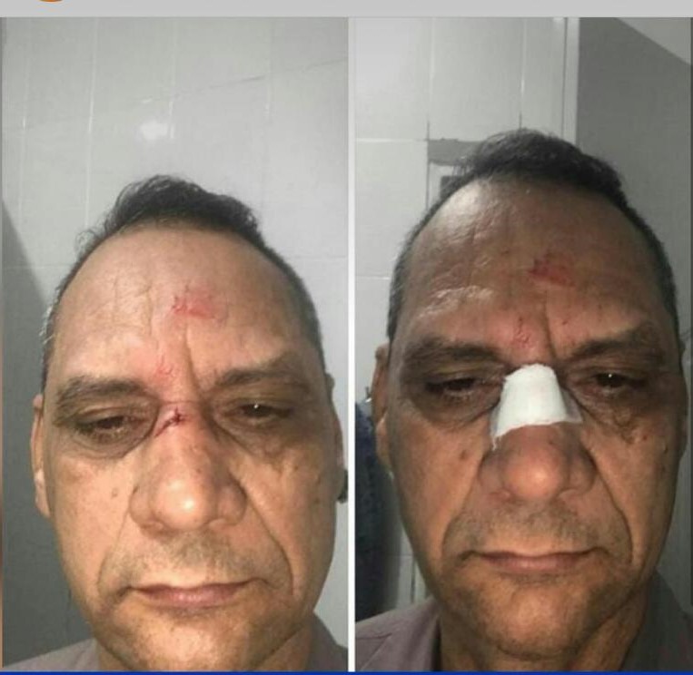 Agreden al director de la Policía Preventiva con una pedrada en el rostro