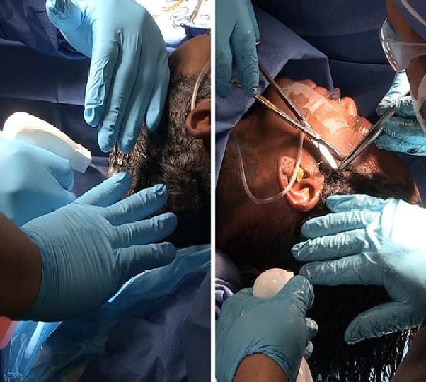 VIDEO | Mira la cirugía que le quitó el pegamento del cabello a la influencer Tessica Brown