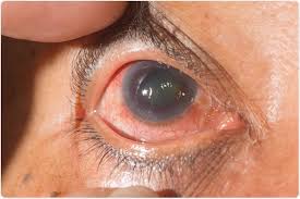 El Glaucoma, un padecimiento que engloba hasta 60 enfermedades oculares