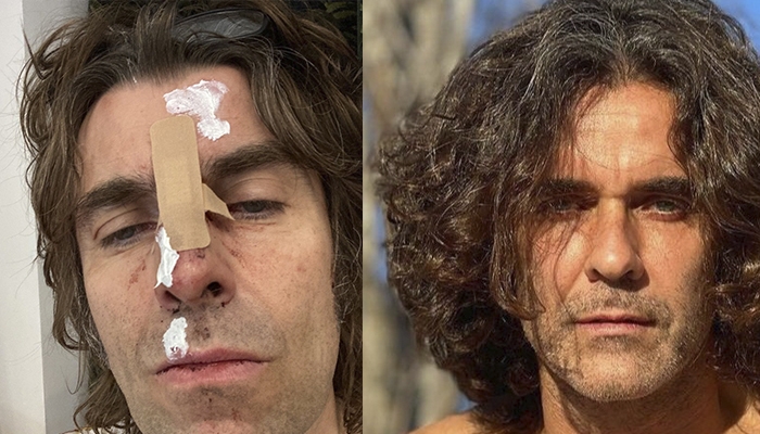 Liam Gallagher aparece herido en una foto luego de "caer de un helicóptero"