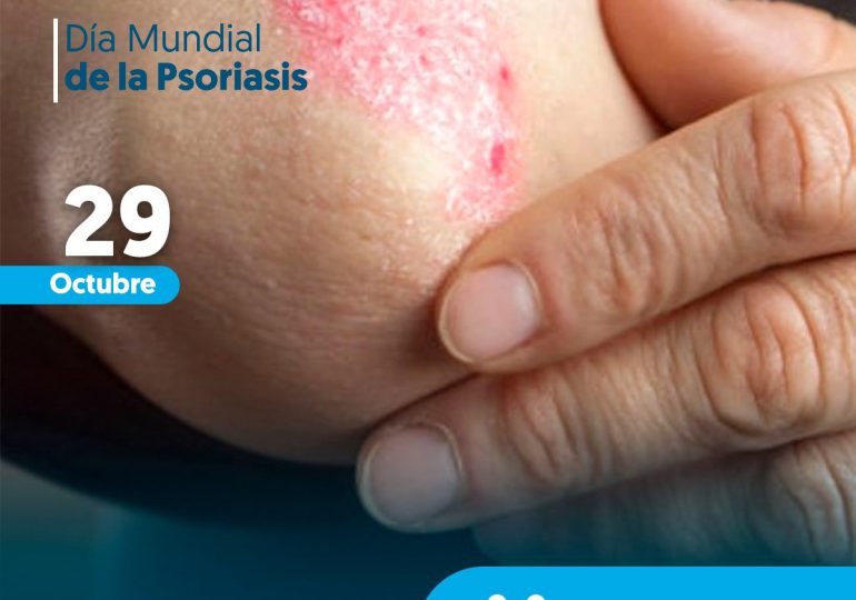 Dermatóloga del Moscoso Puello recomienda a pacientes psoriasis seguir tratamiento