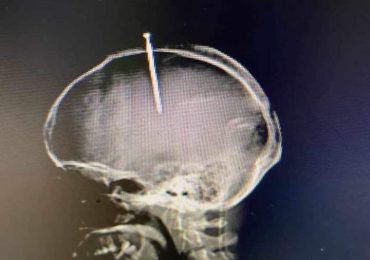 Muere hombre se había intruducido clavo en la cabeza porque ''sentía el cerebro flojo''