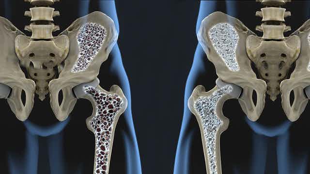 20 de octubre; Día Mundial de la Osteoporosis