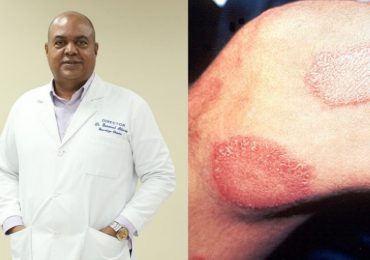Director Moscoso Puello alerta sobre el peligro de la lepra si no se trata en primera fases