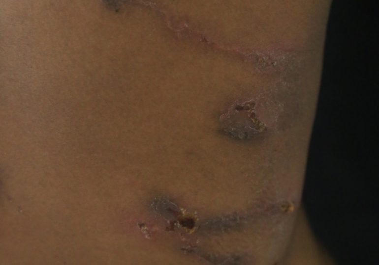 Instituto Dermatológico dice en caso de confirmarse escabiasis en Haití, RD cuenta con tratamientos para su cura