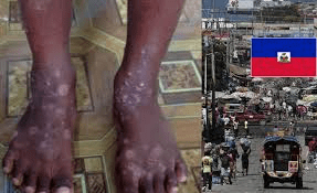Haití alerta sobre infección en la piel “altamente contagiosa”
