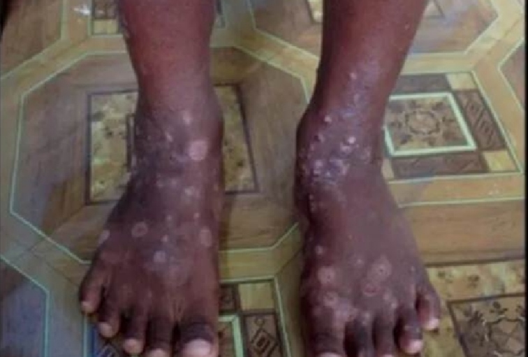 Salud Pública orienta sobre casos de infección cutánea en Haití