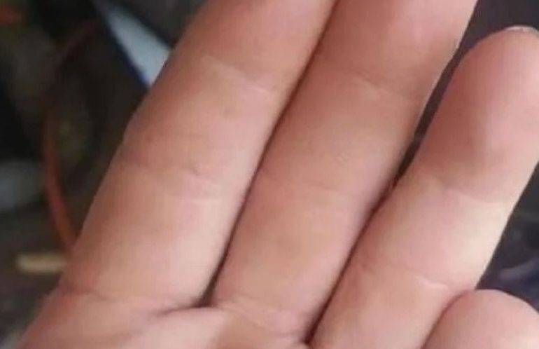 Mujer agrede joven venezolana y le corta un dedo de una mordida