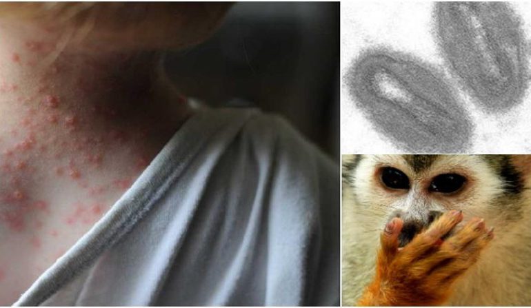 Canadá acumula 15 casos confirmados de viruela del mono