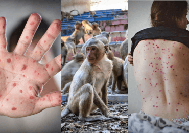 Japón notifica su primer caso de viruela del mono