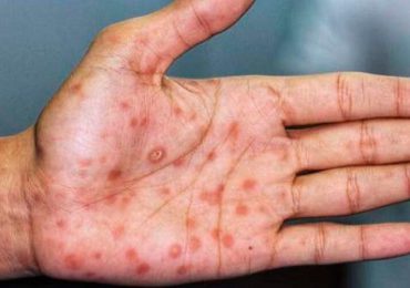 Reportan primer caso de viruela símica en Paraguay