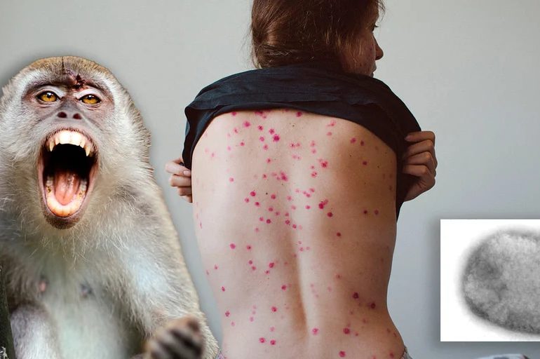 Los interrogantes que persisten sobre la viruela del mono