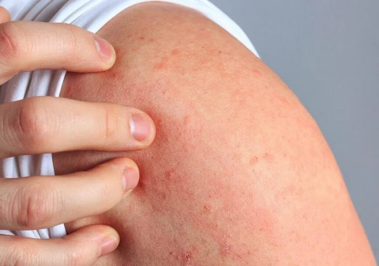 Dermatitis Atópica: enfermedad crónica que afecta a 1 de cada 10 personas