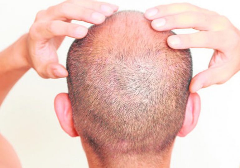 Científicos japoneses logran producir folículos de cabello para combatir la calvicie