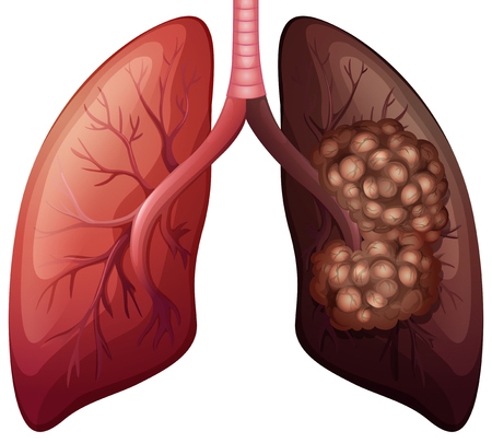 El cáncer de pulmón es el más letal de América Latina