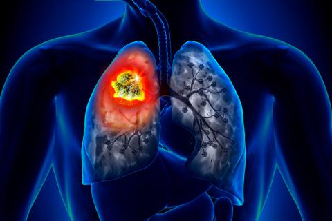 Análisis para la detección de cáncer de pulmón