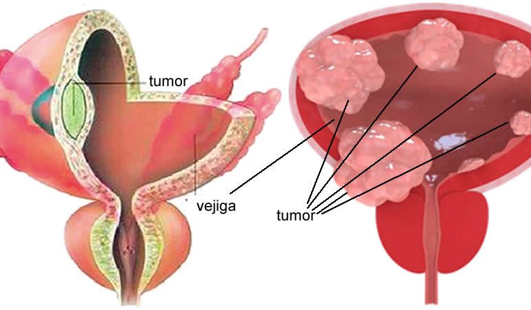 Aumenta incidencia de cáncer de vejiga en jóvenes centroamericanos