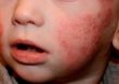 Especialista destaca novedades para el tratamiento de dermatitis atópica en niños