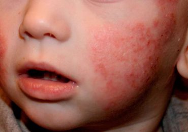 Especialista destaca novedades para el tratamiento de dermatitis atópica en niños
