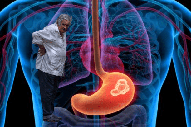Ex presidente José Mujica diagnosticado con cáncer de esófago: conoce más sobre esta enfermedad y su tratamiento