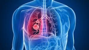60% de los pacientes con cáncer de pulmón avanzado ALK positivo viven más de cinco años sin progresión de la enfermedad, señala estudio