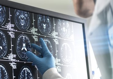 Nuevos tratamientos contra el alzheimer: ¿revolución o ilusión?