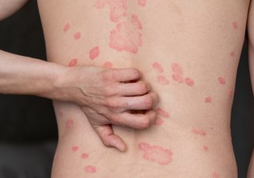 El impacto oculto de la psoriasis: más allá de una enfermedad en la piel