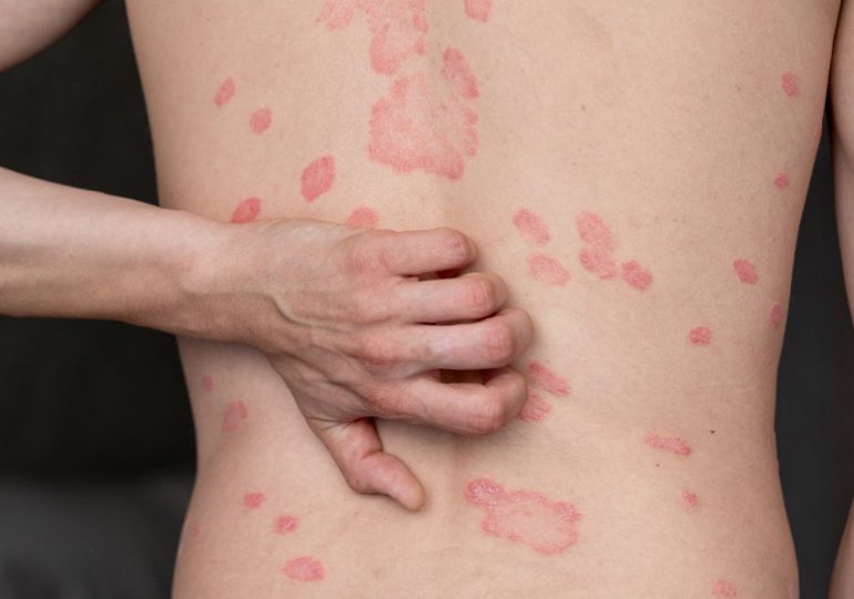 El impacto oculto de la psoriasis: más allá de una enfermedad en la piel