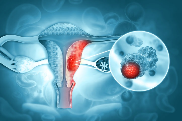 Cada dos días en República Dominicana una mujer es diagnosticada con cáncer de ovario, según estudios