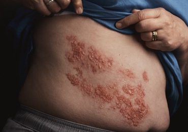 Los 8 mitos más comunes del herpes zóster o mejor conocido como “culebrilla”