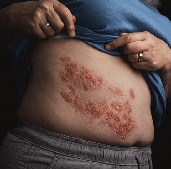 Los 8 mitos más comunes del herpes zóster o mejor conocido como “culebrilla”