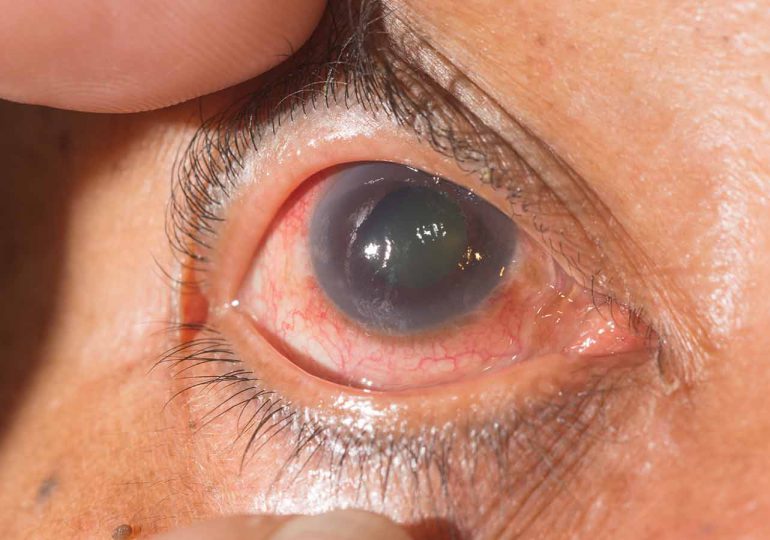 Glaucoma: Cómo evitar la ceguera con un diagnóstico a tiempo