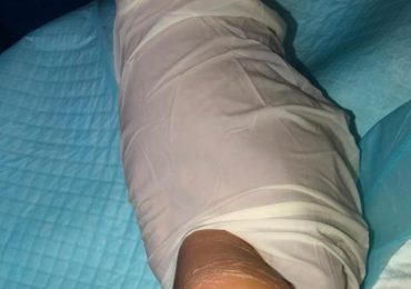 Madre lanza recaudación de fondos para su bebé con celulitis y absceso en sus piernas