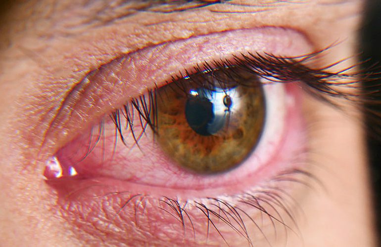 El ojo seco: una molestia cotidiana que puede convertirse en una condición crónica