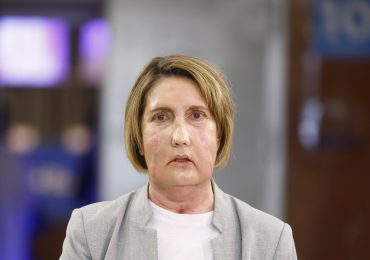 Hospital de Barcelona hace el primer trasplante de cara del mundo con donante de eutanasia